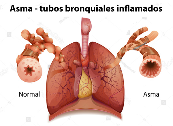 Estados bronquiales